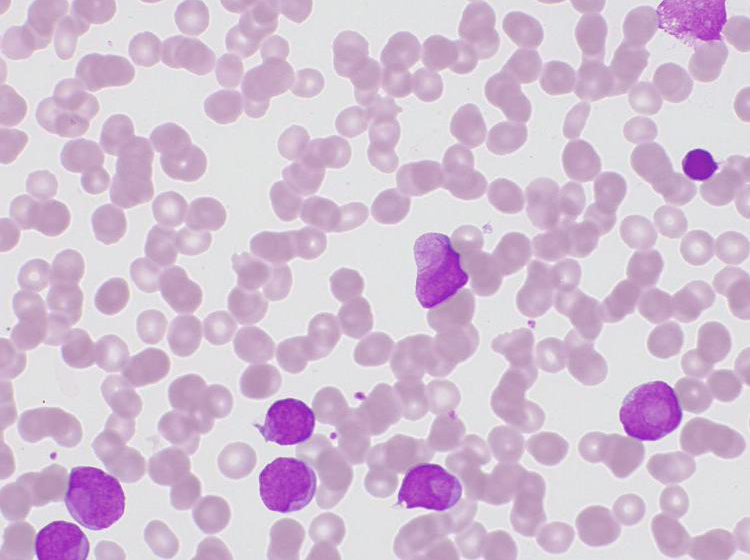 Bone marrow in brightfield, Auer rod. Acquired with ZEISS Axioscope 5