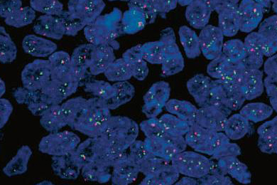 HER2 centromere, fluorescence contrast, Brockhoff working group, Institute of Pathology, University of Regensburg, Germany
