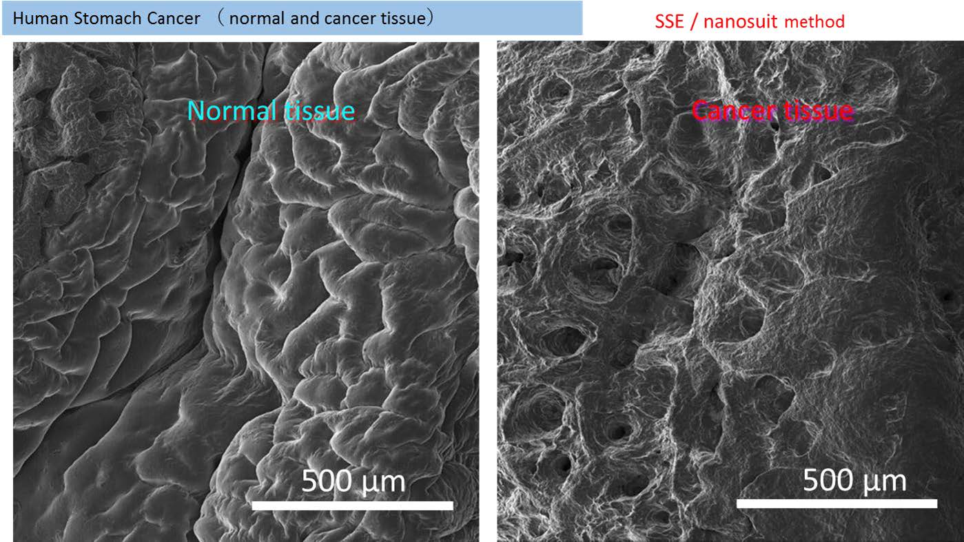 Normal Issue vs Cancer Issue