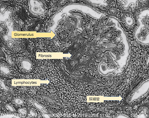 NanoSuit - pathological specimen - Nephritis